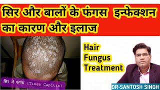 What are Hair Fungus infection TINEA CAPITIS  and its Cause Symptoms and Treatment [upl. by Levi455]