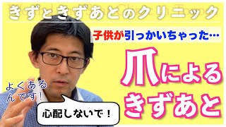 よくある爪の引っかき傷の治療方法、ケアを教えます。 [upl. by Harimas]