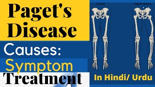 What is Paget Disease Causes Sign and Symptoms Diagnosis Treatment In Hindi  Medical Practice [upl. by Azilef]