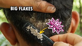 Dry Flaky Scalp Removal Dandruff Scratching Satisfying 277 [upl. by Enytsuj]