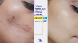 Clindamycin antibiotic  Clindamycin phosphate topical solution how  Heena Tries It  Heena [upl. by Assirialc]