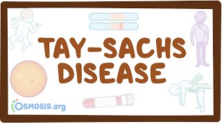 TaySachs disease  causes symptoms diagnosis treatment pathology [upl. by Bitthia]