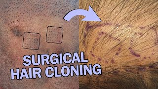 What is Surgical Hair Cloning surgicalhaircloning [upl. by Anaile]