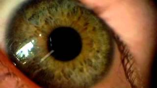 Eyeball dilation up close 2 [upl. by Greenstein487]