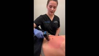 Morpheus8 Treatment to Abdomen  Dr David P Rapaport NYC [upl. by Gefell148]