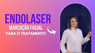 Endolaser  Marcação Facial para o Tratamento [upl. by Nixon348]