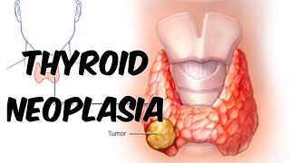 Thyroid Neoplasia [upl. by Kila]