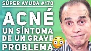 SÚPER AYUDA 170 Acné Un Síntoma De Un Grave Problema [upl. by Anastatius]