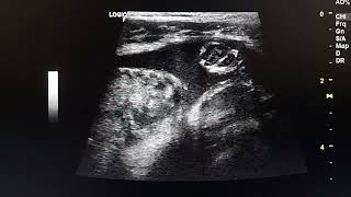 Meckel diverticulum perforation ultrasound case [upl. by Olav62]