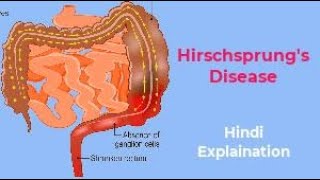 Hirschsprungs Disease  Congenital Megacolon  Symptoms  Pathophysiology  Nursing Management [upl. by Nynahs916]