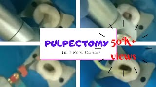 pulpectomy PULPECTOMY STEP BY STEPKEDO SG BLUE FILESINGLE SITTING PULPECTOMY IN 4ROOT CANALS [upl. by Norina]