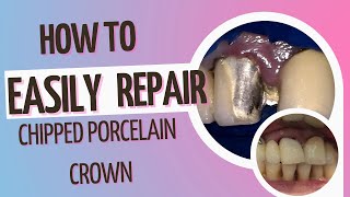 How to repair a chipped Porcelain crown directly and chairside [upl. by Ali]