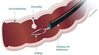 Kolorektales Karzinom [upl. by Corty]
