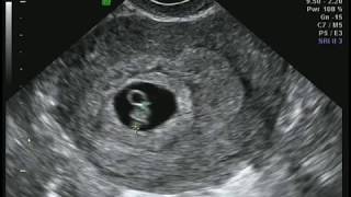 6 weeks 5 days ultrasound [upl. by Yerfdog]