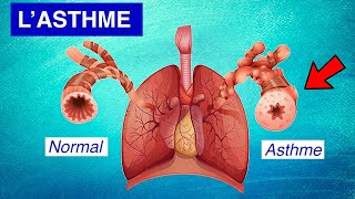 Asthme bronchique  Physiopathologie Symptômes et Traitements [upl. by Tehc]