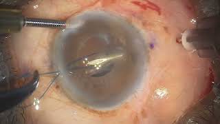 Belt Loop technique for scleralRefixation of Subluxated IOL [upl. by Nosyerg653]