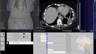 CT Scan of Chest with contrast full work quot SEIMENSquot [upl. by Arlyne]