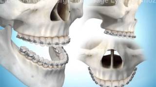 Basics of Osteotomy [upl. by Eegnat]