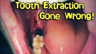 Wisdom Teeth Removal Extraction [upl. by Incrocci]