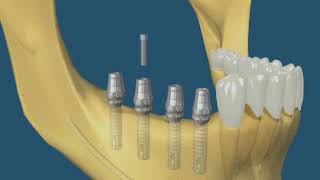 Reabsorção óssea  implantes [upl. by Steele]