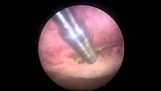 Endometrial polyp [upl. by Yerdua]