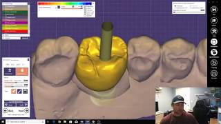 Scan Body and Screw Retain Implant Crown Design [upl. by Ardys]