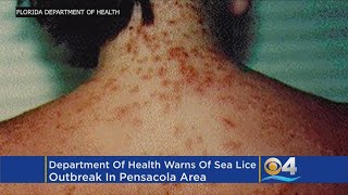 Department Of Health Warns of Sea Lice Outbreak [upl. by Persons]