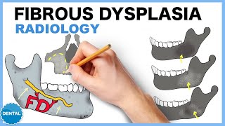 Fibrous dysplasia Radiology [upl. by Sirovart452]