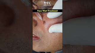 Removing Face Warts Safely and Effectively Treatment Options at DTC Skin Clinic [upl. by Eiramesor]