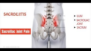 सैक्रोइलिइटिस  Sacroiliitis PAIN  कारण लक्षण और निदान एवं लाभदायक योग [upl. by Tsnre]