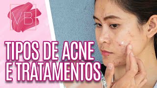 Acne tipos causas e melhores tratamentos  receita caseira  Você Bonita 101121 [upl. by Ximenes]