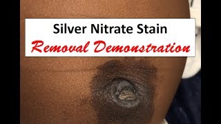 Silver Nitrate Skin Stain Removal [upl. by Ecidnacal]