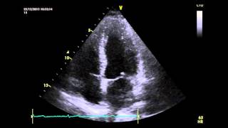 Apical 4 chamber view of a normal heart [upl. by Holmes]