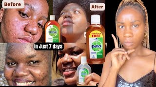 How to use DETTOL Antiseptic Liquid for face Acne Chemist reacts [upl. by Bing]