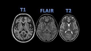 MRI t1 vs t2 [upl. by Humble]