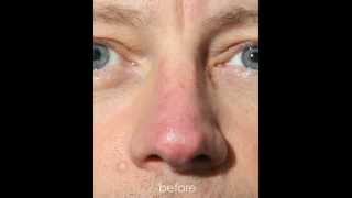 Couperose of the Nose Intense Pulsed Light IPL Treatment [upl. by Juliet]