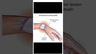 Treatment Of Dequervain Tenosynovitis ImMobile the area surrounded your thumb [upl. by Nepean516]