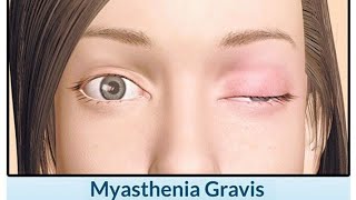 Myasthenia Gravis causes of myasthenia gravis clinical features of myasthenia gravis [upl. by Adnale]