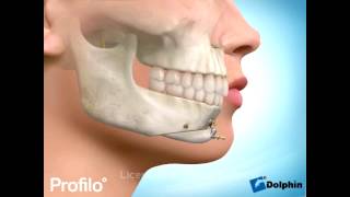 Chin Augmentation Surgery Genioplasty [upl. by Eeuqram]