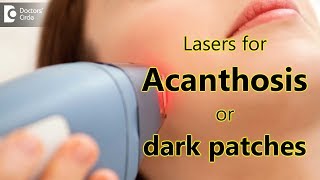 Are Laser effective in Acanthosis nigrans patients  Dr Rajdeep Mysore [upl. by Reidar]