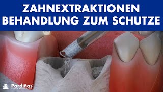 Zahnextraktionen – Behandlung zum Schutze des Zahnfaches © [upl. by Herv]