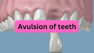 What is Avulsion of teeth [upl. by Rainah510]