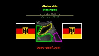 Sonographie  Cholezystitis [upl. by Ahsenak]