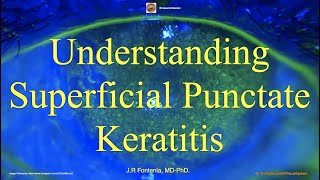 Understanding Superficial Punctate Keratitis [upl. by Caldwell11]