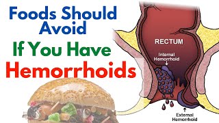 9 Foods That Make Hemorrhoids Worse  Foods To Avoid For Hemorrhoids [upl. by Ahsilam]