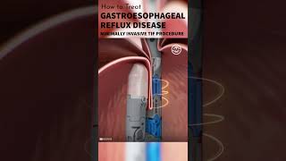 Gastroesophageal Reflux Disease GERD Treatment shorts tutorial medical animation surgmedia [upl. by Orella]