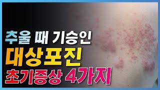 대상포진 초기증상 4가지와 관리법 알려드립니다 [upl. by Sears]