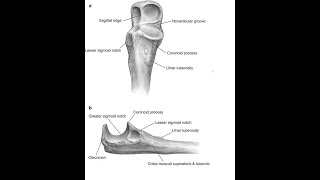 Olecranon Osteotomy Approach [upl. by Sharline918]