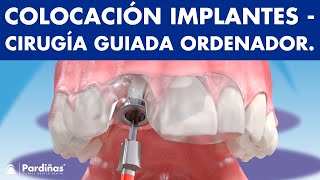 Cirugía guiada por ordenador para colocar IMPLANTES DENTALES© [upl. by Janette995]