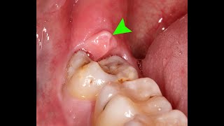 Pericoronitis  Swollen gums  Gums Inflammation  Pain in gums  Paininwisdomtooth [upl. by Ahtel]